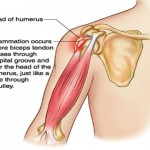 what is tendinitis