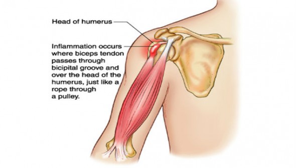 what is tendinitis