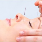 cosmetic acupuncture